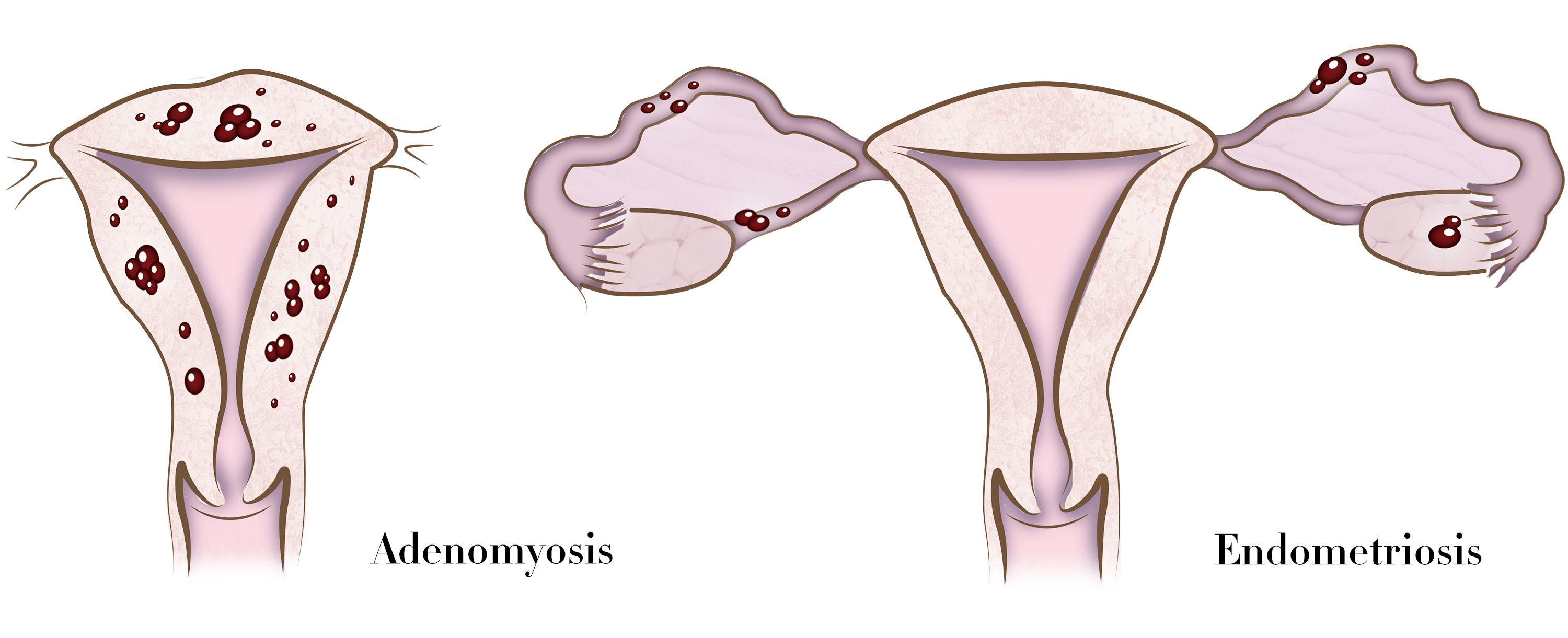 mc-adenomyosis-illo-1498161855